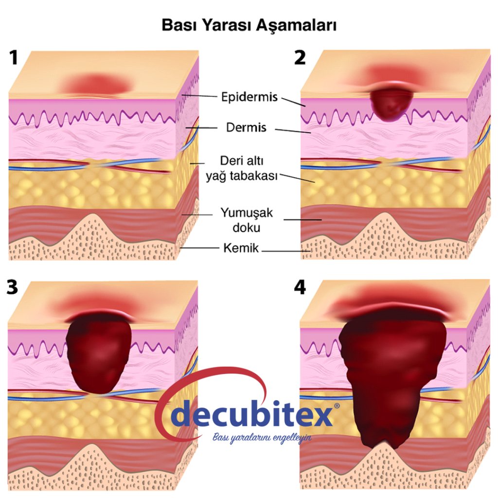 bası yaraları aşamaları